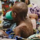 Mpox: Equitable vaccine access crucial for Global South