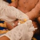 Mpox: UNHCR launches $21.4 million appeal to support refugees in African countries