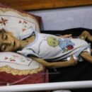 Gaza: Acute malnutrition among children hits record high