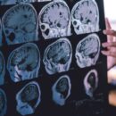 New guidance offers hope for reducing the global toll of dementia